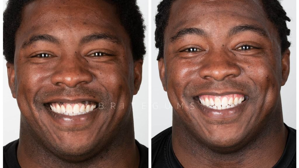 How To Clean Black Gums