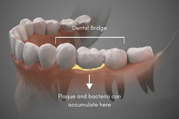 How To Clean Dental Bridge How To Clean Dental Bridge