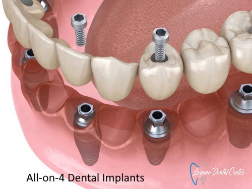 How To Clean Dental Implants How To Clean Dental Implants