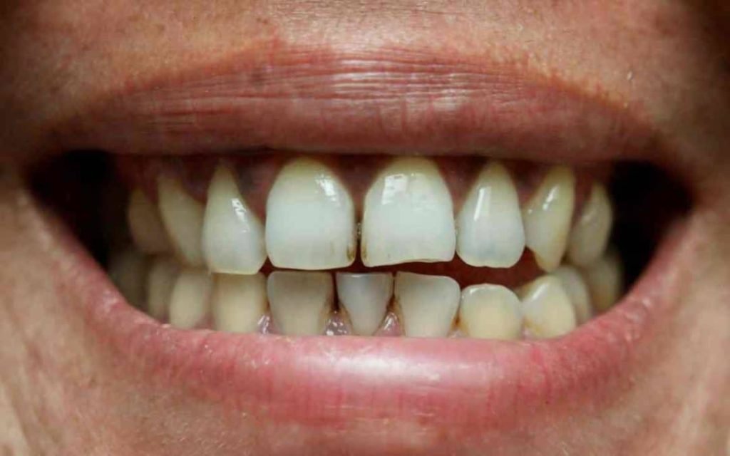 How To Clean Stains Between Teeth How To Clean Stains Between Teeth