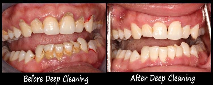 Do Gums Grow Back After Deep Cleaning