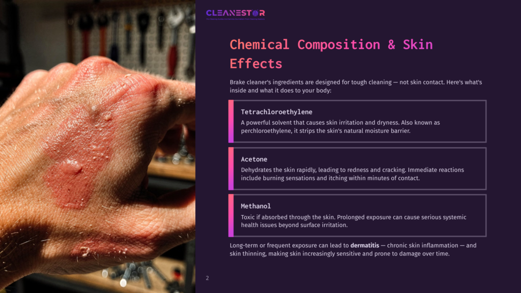 Close-Up Of A Person'S Hand Showing Severe Chemical Burns And Blistering, Likely From Exposure To Brake Cleaner Ingredients Like Tetrachloroethylene Or Methanol.